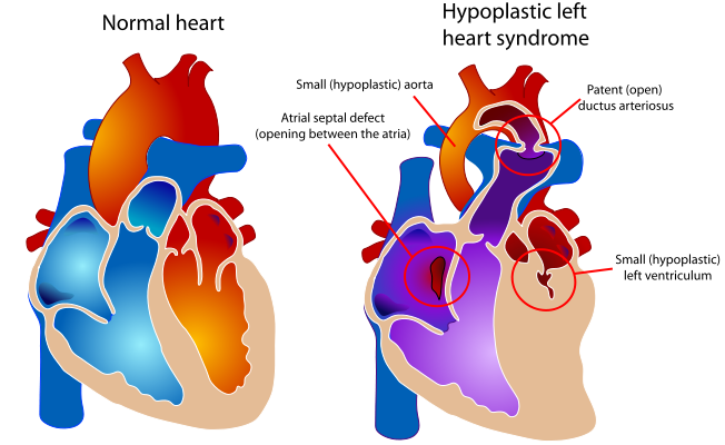 667px-hypoplastic_left_heart_syndrome.svg